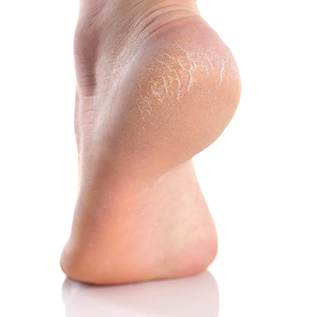 Best Products For Cracked Heels - Silipos
