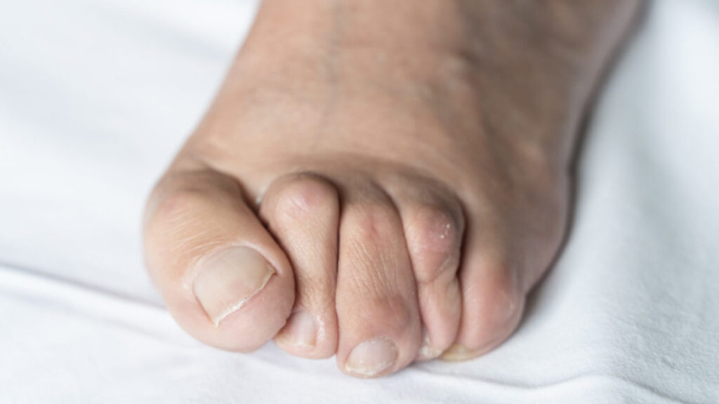 Hammertoe Relief